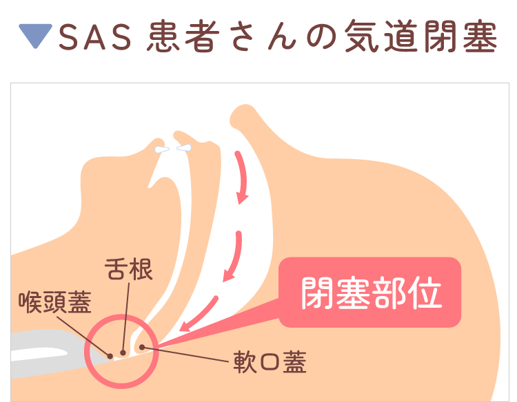 上気道閉塞の緊急治療